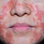 dermatite séborrhéique
