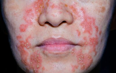 dermatite séborrhéique