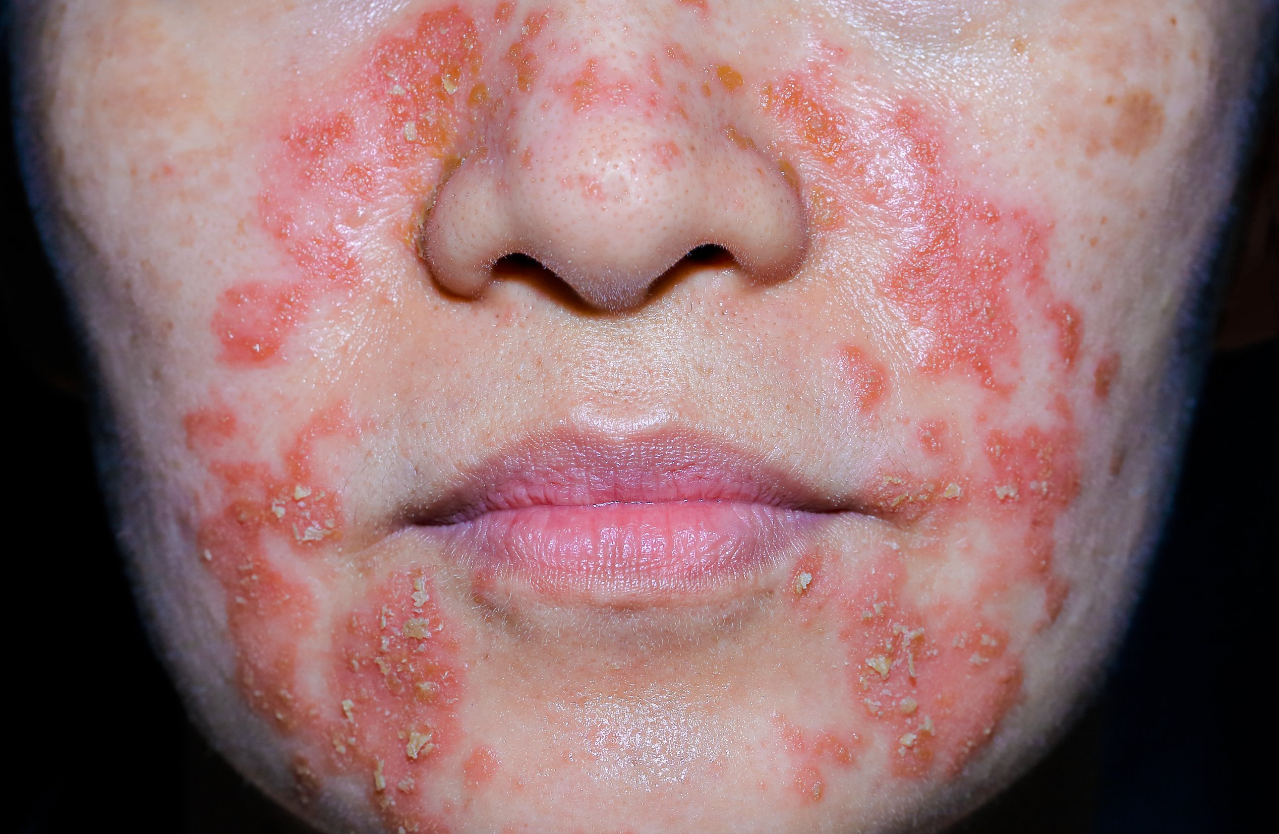 dermatite séborrhéique